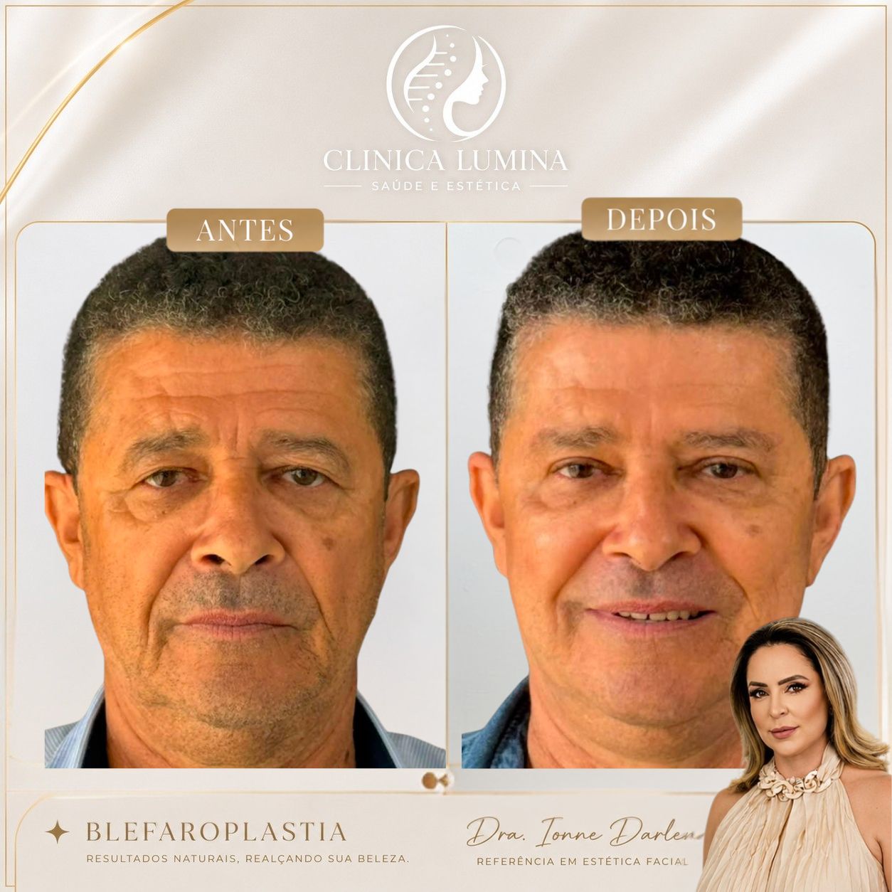 Antes e depois de blefaroplastia masculina na Clínica Lumina