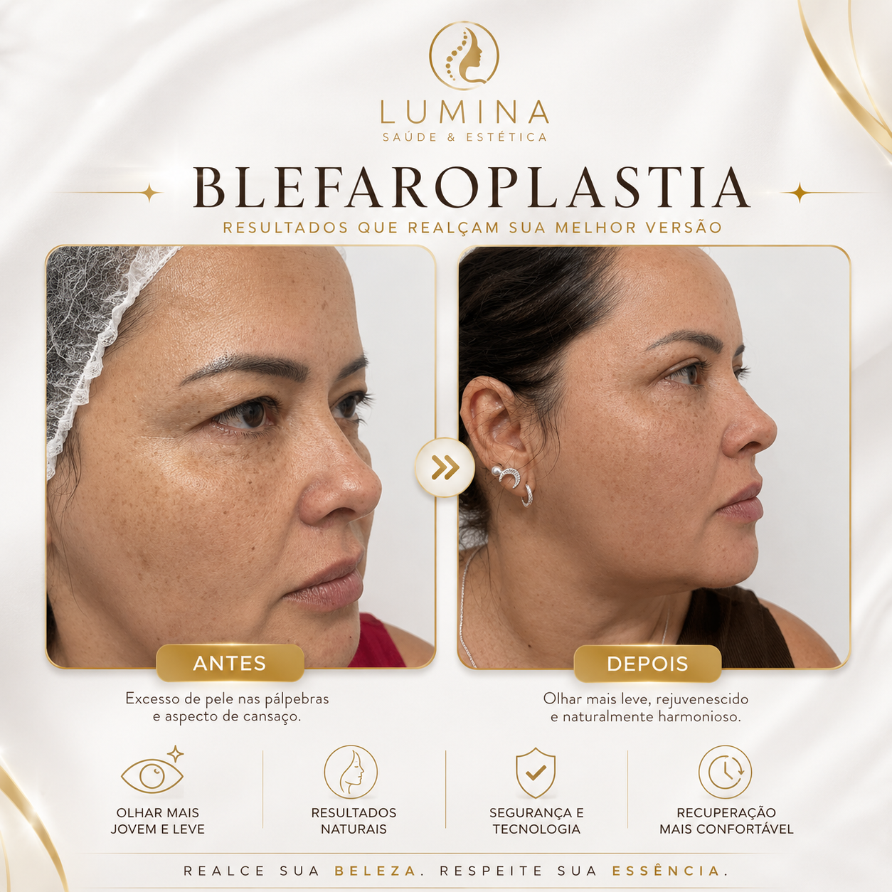 Antes e depois de blefaroplastia em perfil, paciente da Clínica Lumina