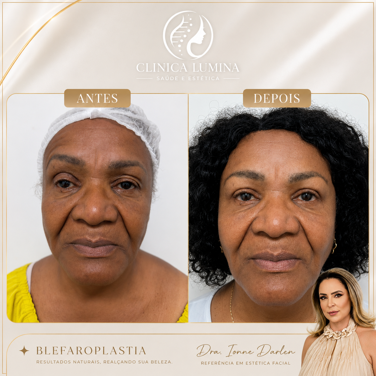 Resultado de blefaroplastia em paciente da Clínica Lumina