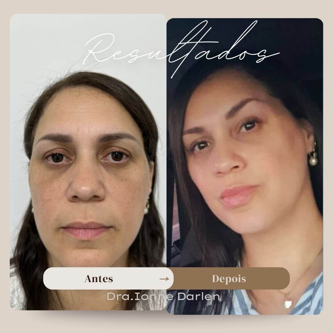 Resultado real de blefaroplastia — paciente da Dra. Ionne Darlen