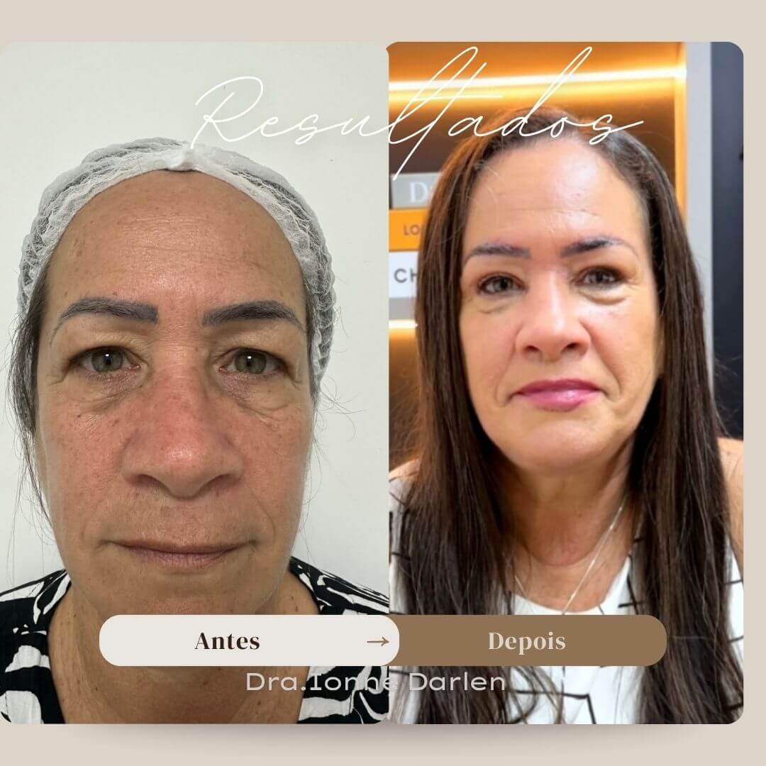 Resultado real de blefaroplastia superior — pálpebra mais aberta e olhar rejuvenescido
