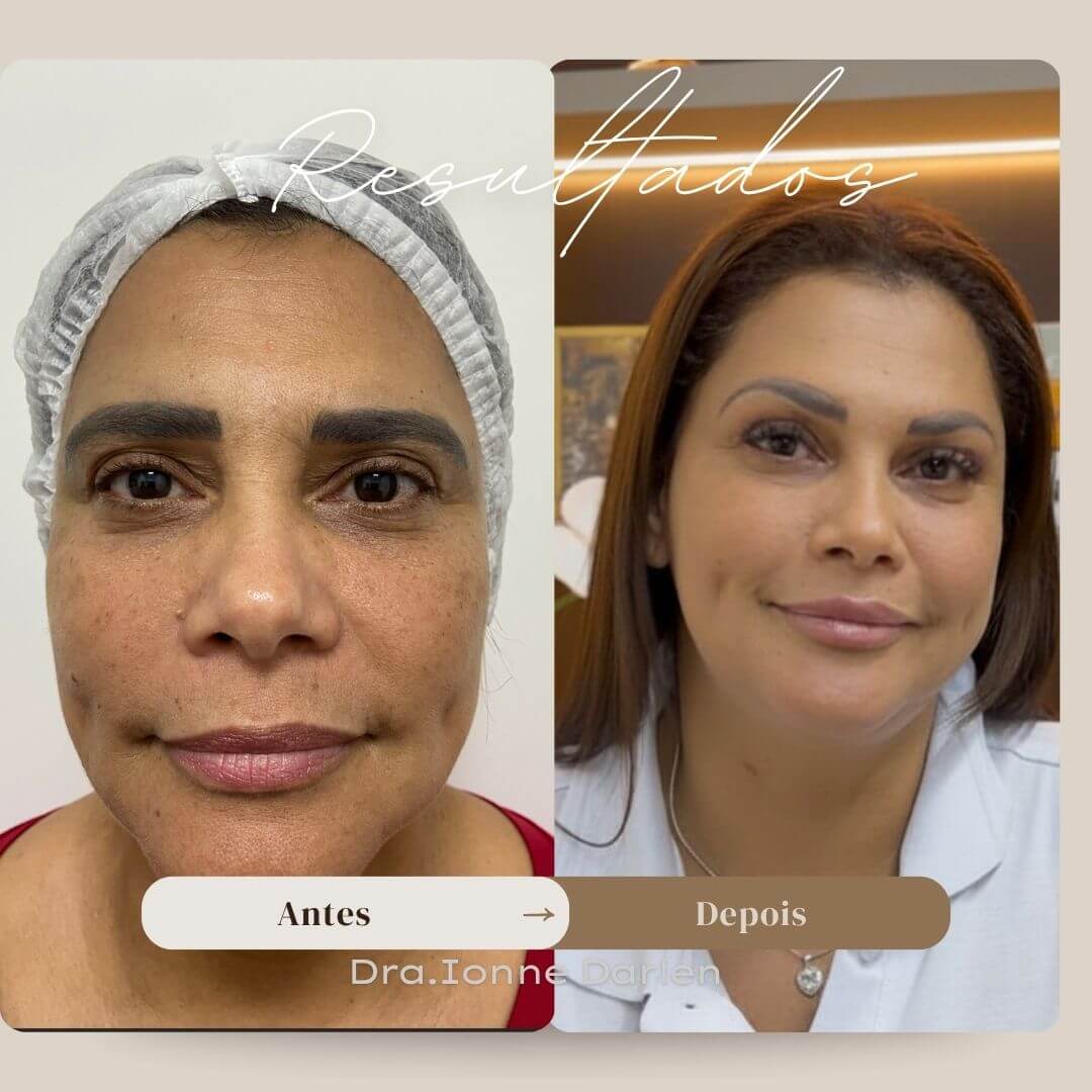 Antes e depois de blefaroplastia — pele renovada e olhar com mais frescor