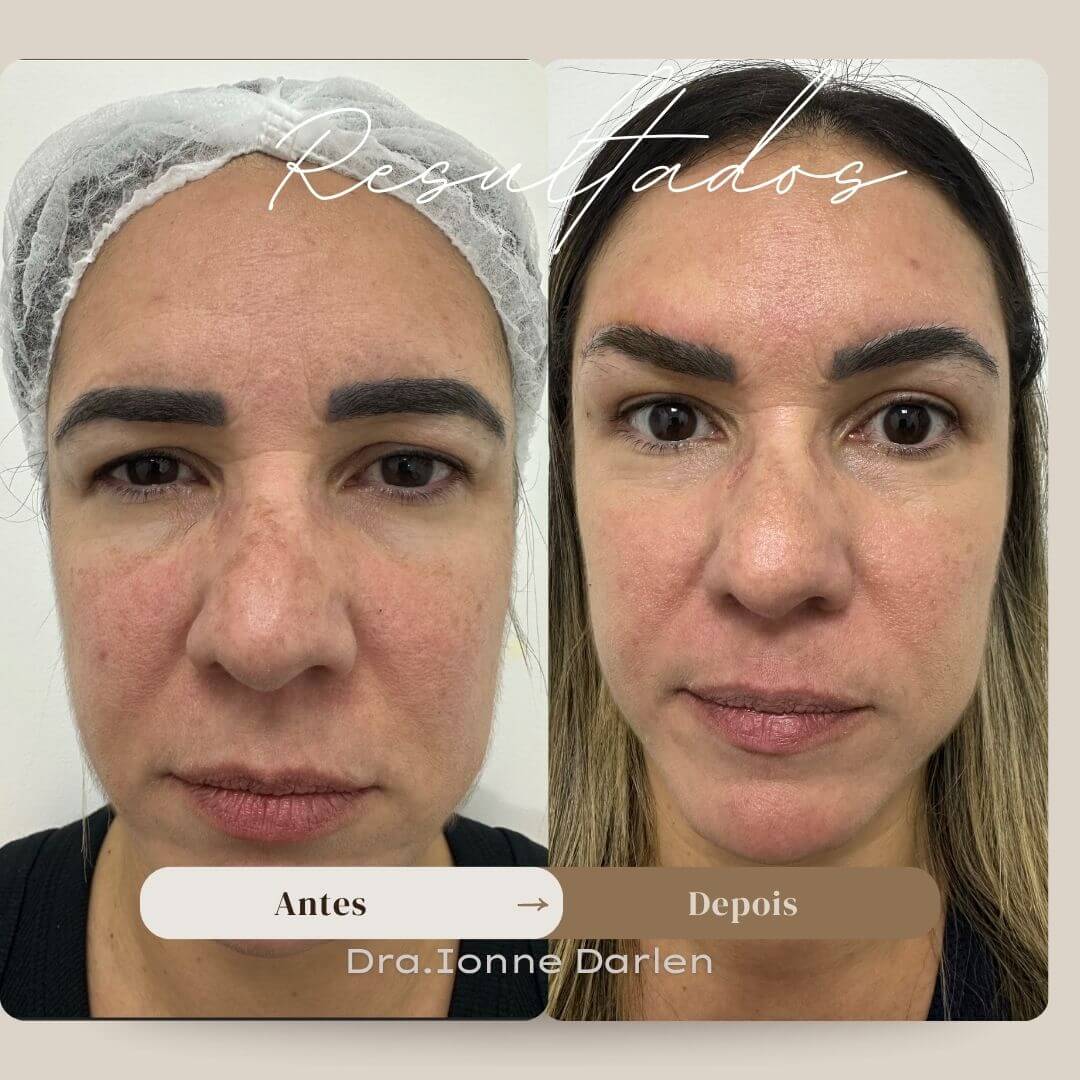 Resultado natural de blefaroplastia — expressão preservada, olhar mais jovem